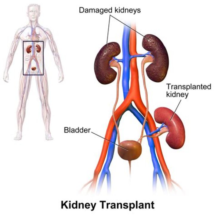 Understanding The Journey Of Kidney Transplant Scars